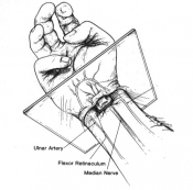 One through the median nerve