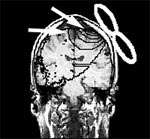 TMS stimulation